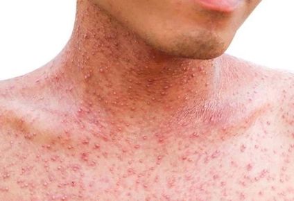 rige un alerta epidemiologico por cuatro casos de sarampion en la ciudad de buenos aires