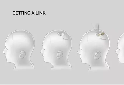 Dibujo de los diferentes pasos de la implantación del dispositivo interfaz de Neuralink en el cerebro.