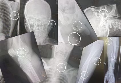 Radiografías de heridos de bala ingresados al hospital del Cerro