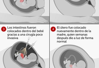 un pequeno milagro: como una cirugia fetal pionera salvo la vida de un bebe que crecia con sus intestinos fuera de su cuerpo